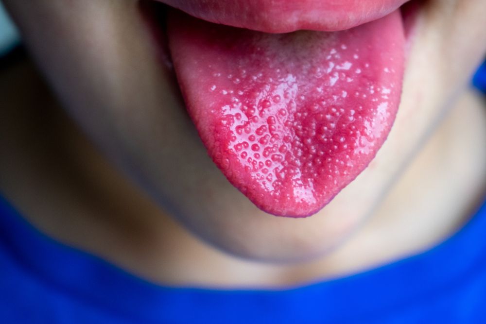 Strawberry,Tongue,,Sign,Of,Streptococcus,Infection