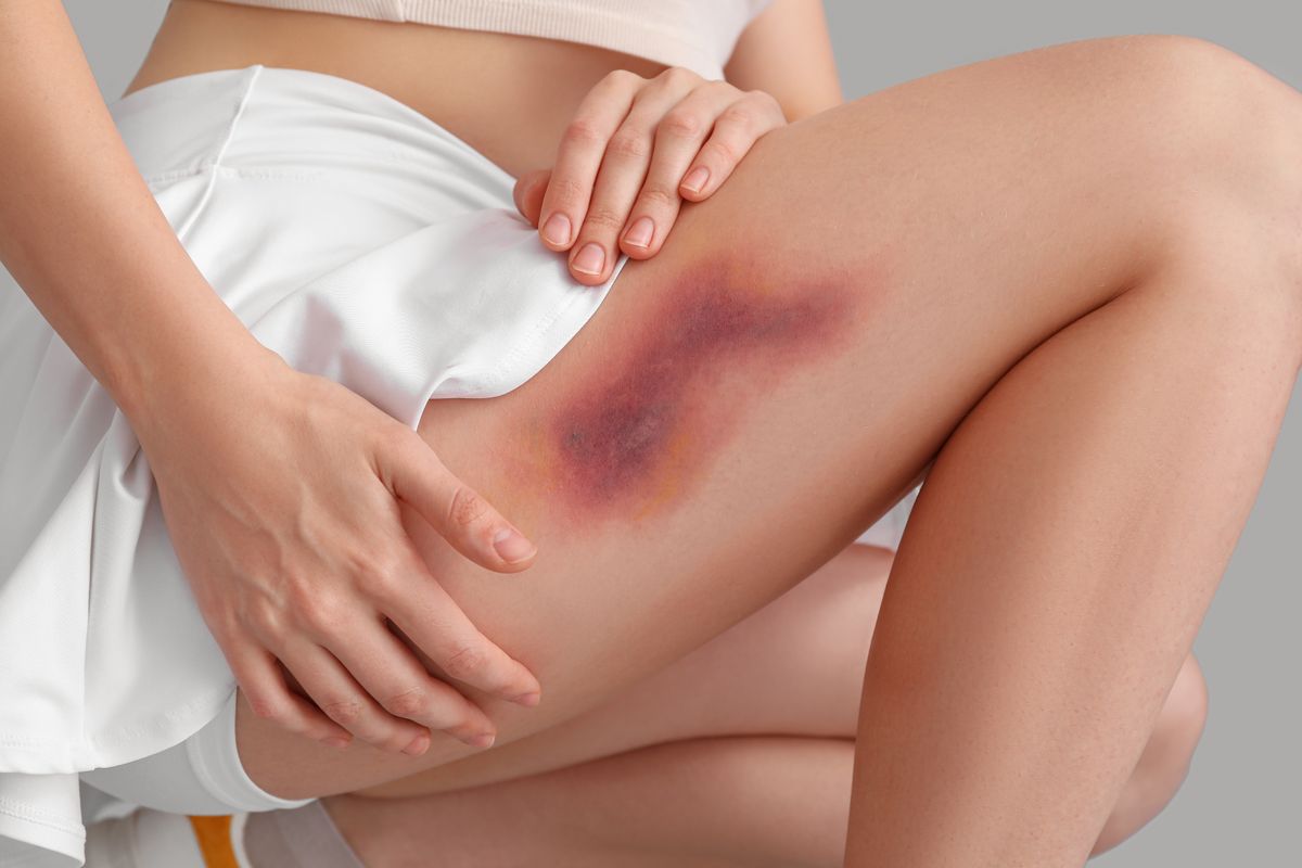 Young,Woman,With,Bruised,Leg,On,Grey,Background,,Closeup