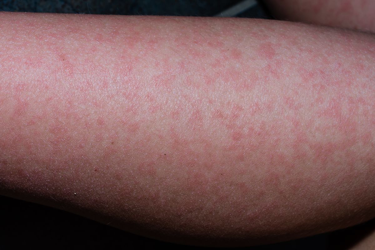 The,Rash,From,Fifth,Disease,On,A,Child.