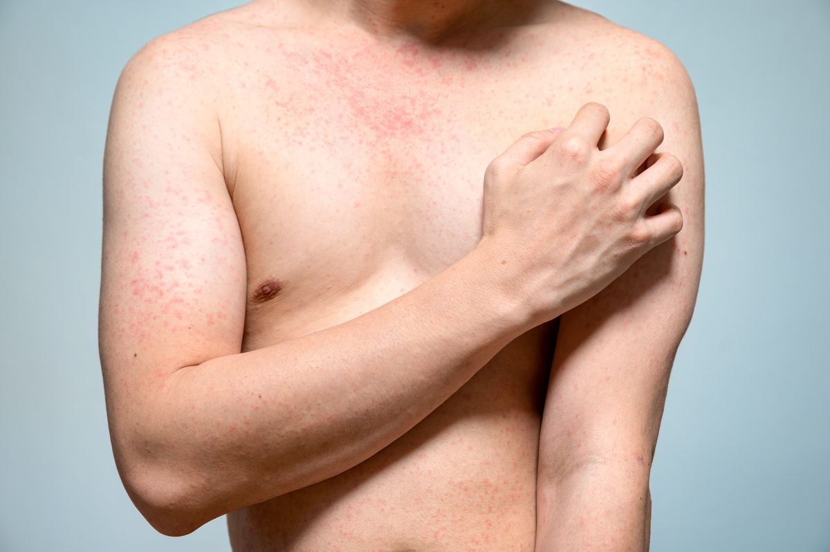 Dermatitis,Rash,Viral,Disease,With,Immunodeficiency,On,Body,Of,Young