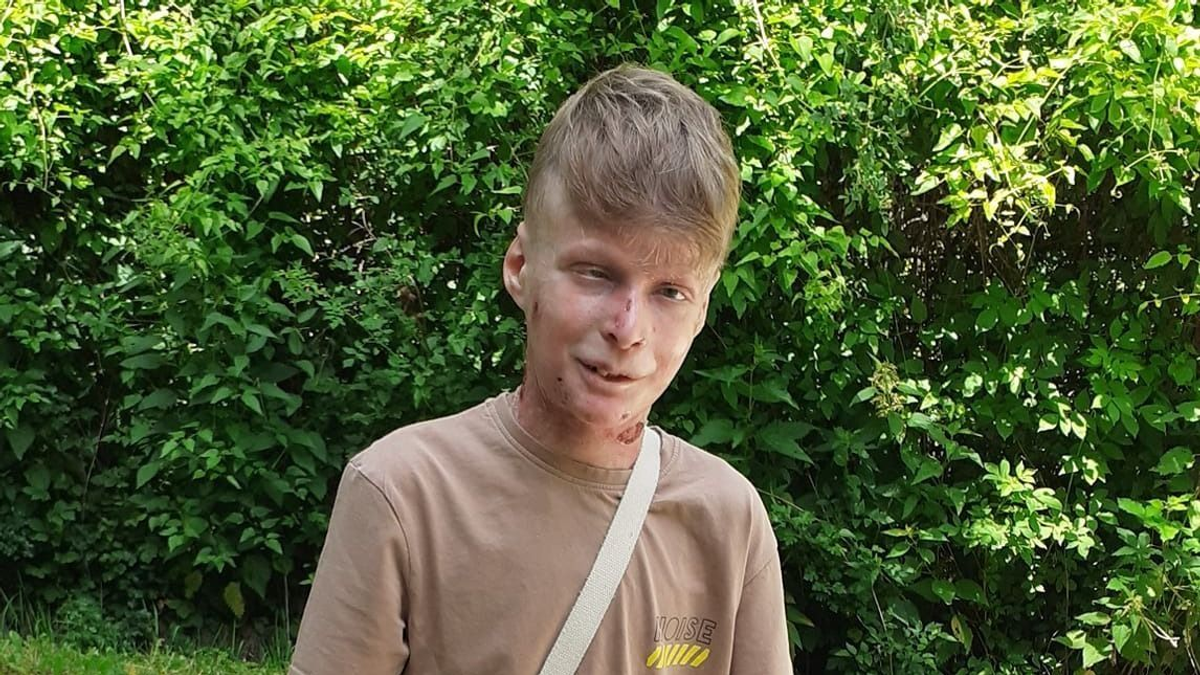 Flórián, a bőrbeteg tini állapota romlani kezdett