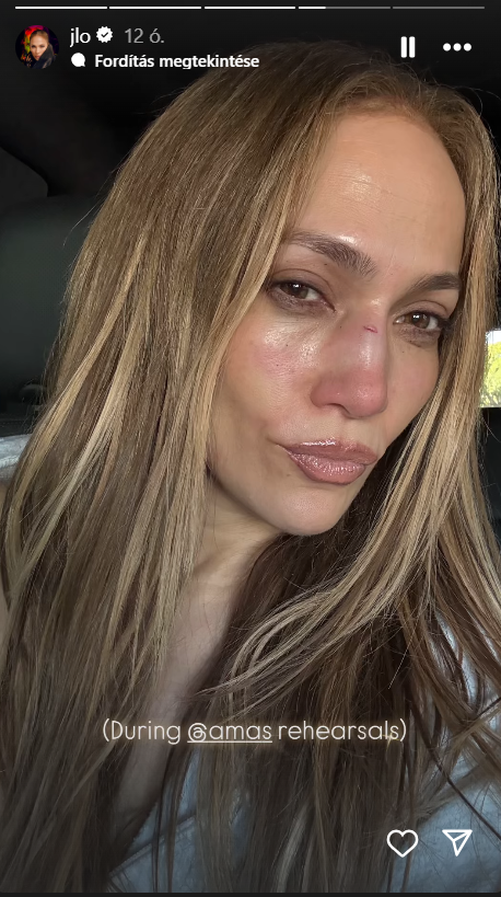 Jennifer Lopez balesetet szenvedett
