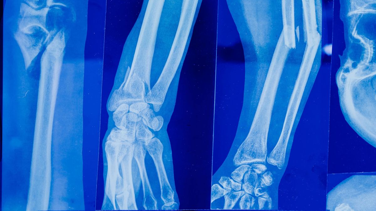 Ne várd meg az első törést! A csontritkulás elleni harc a konyhádban kezdődik