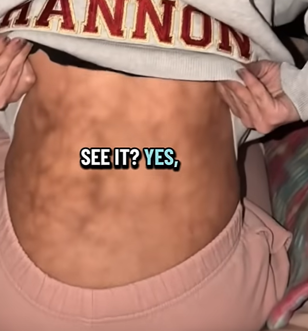 Megpirította bőrét a melegítőpárna