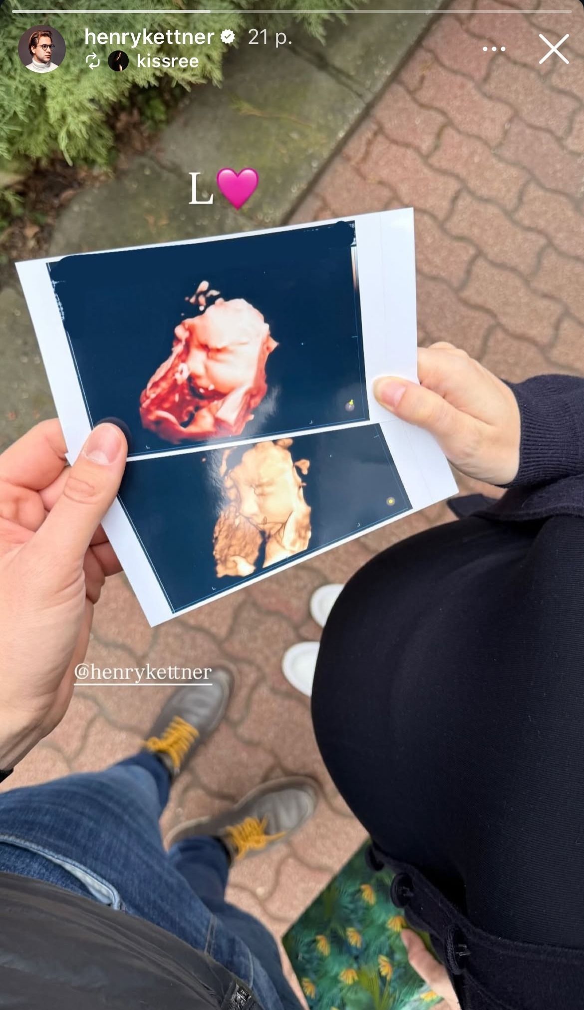 Henry Kettner kislánya-ultrahang fotó