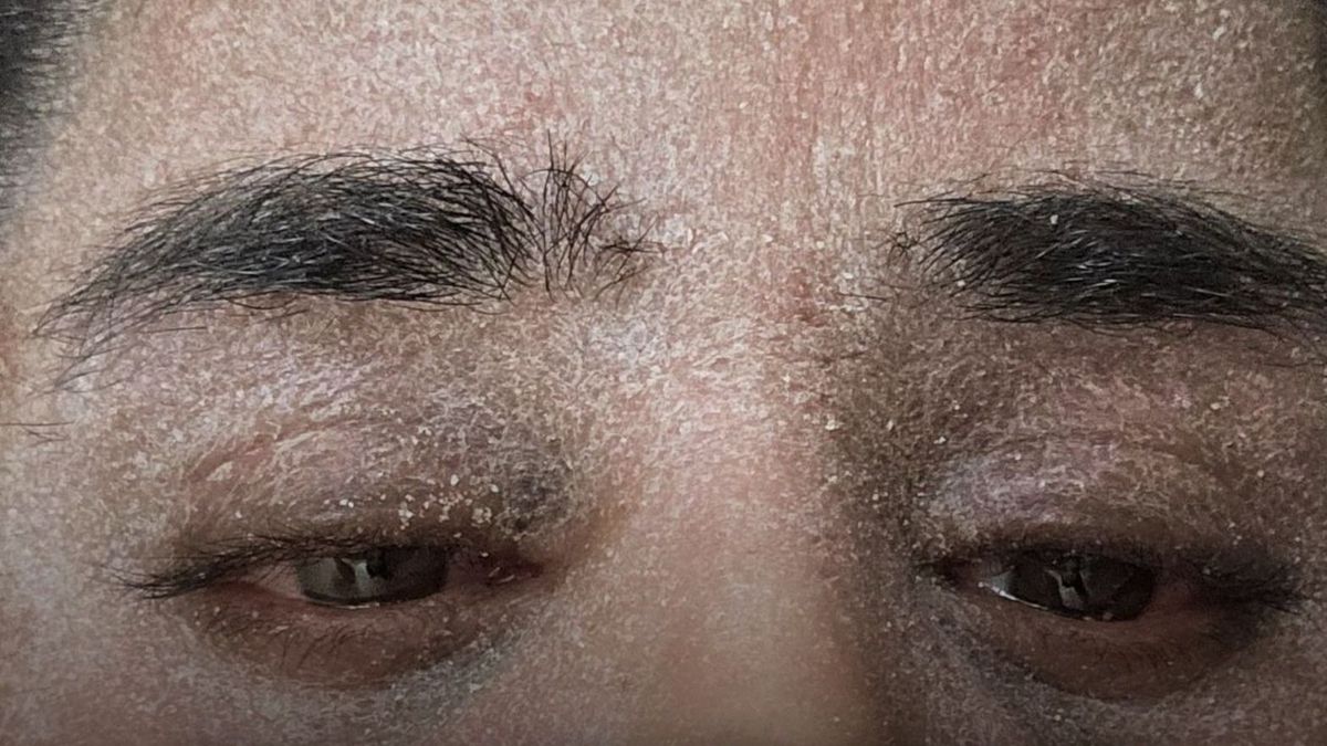 Sharn elefántbőrrel küzd, mert elvonási tünetei vannak. Fotó: Facebook/Mirror